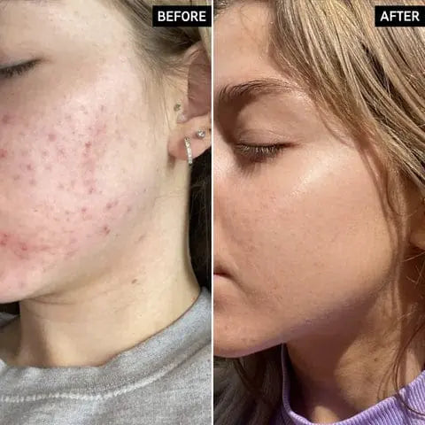 Ordinary Niacinamide 10% + Zinc 1% - 30ml